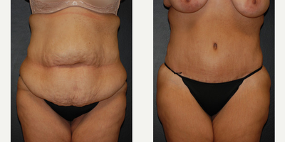 Case 496 - Woman treated with Tummy Tuck