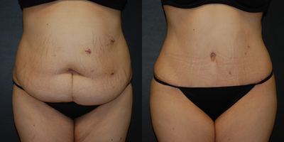 Case 497 - Woman treated with Tummy Tuck