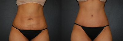 Case 498 - Woman treated with Tummy Tuck