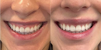 Case 4980 - 25-34 year old woman treated with Botox for gummy smile