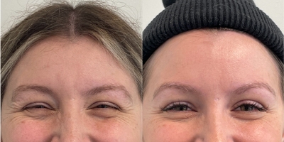 Case 4986 - 25-34 year old woman treated with Botox