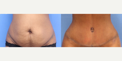 Case 499 - Woman treated with Tummy Tuck
