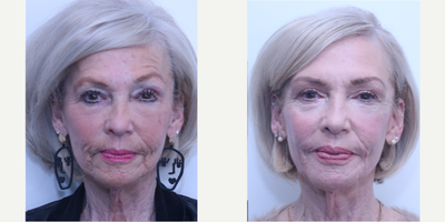 Case 4999 - 65-74 year old woman treated with Eyelid Surgery, Halo Laser, Botox