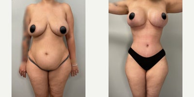 Case: 5 - before and after photo of Woman treated with Tummy Tuck by S. Alexander Earle, MD, FACS