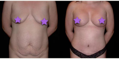 Case 50 - Woman treated with Tummy Tuck