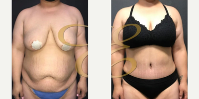 Case 500 - 36 year old woman treated with Tummy Tuck