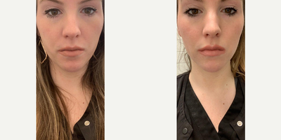 Case 5005 - Woman treated with Dysport, Botox