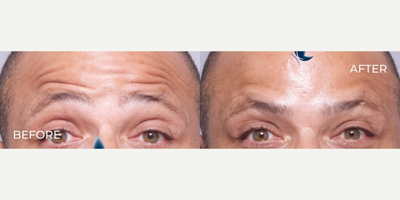 Case 5006 - Man treated with Botox