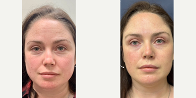 Case 5031 - 35-44 year old woman treated with Botox