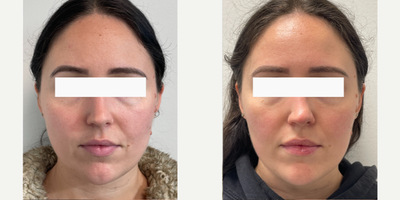 Case 5049 - 25-34 year old woman treated with Botox