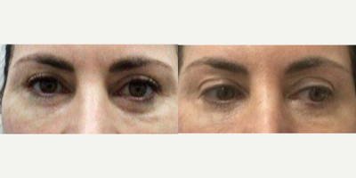 Case 5055 - 45-54 year old woman treated with Botox