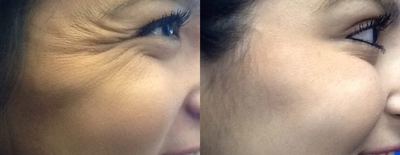 Case 5067 - 25-34 year old woman treated with Botox