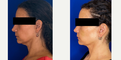 Case 5096 - 46 year old woman treated with Botox