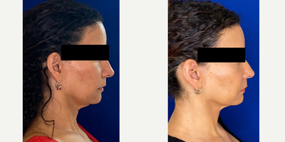 Case 5097 - 46 year old woman treated with Botox