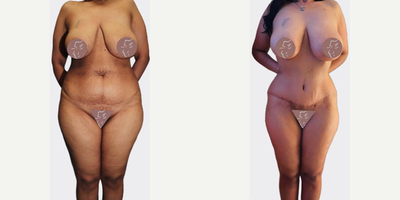 Case 513 - Tummy Tuck