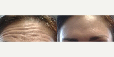 Case 5130 - Woman treated with Botox
