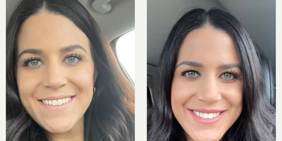 Case 5132 - Woman treated with Dermal Fillers, Lip Lift, Lip Fillers, Juvederm, Botox