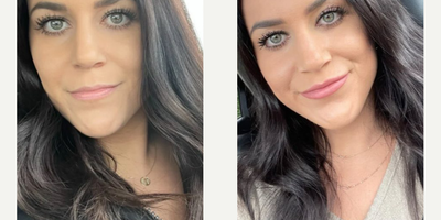 Case 5133 - Woman treated with Dermal Fillers, Lip Lift, Lip Fillers, Juvederm, Botox