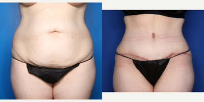 Case 514 - 35-44 year old woman treated with Tummy Tuck