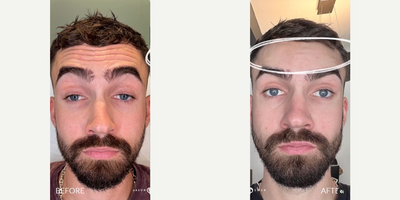 Case 5146 - Man treated with Botox