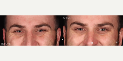 Case 5147 - Man treated with Botox