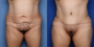 Case 515 - 35-44 year old woman treated with Tummy Tuck