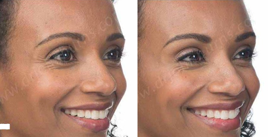 Case 5150 - Woman treated with Botox