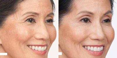 Case 5151 - Woman treated with Botox