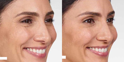 Case 5152 - Woman treated with Botox