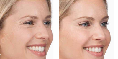 Case 5153 - Woman treated with Botox