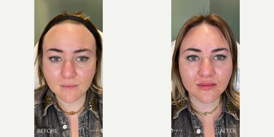 Case 5154 - 35-44 year old woman treated with Botox