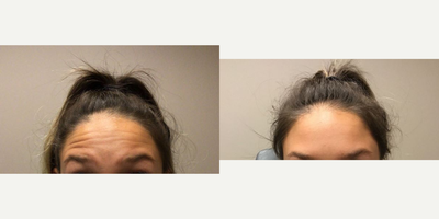 Case 5158 - 25-34 year old woman treated with Botox
