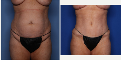Case 516 - 45-54 year old woman treated with Tummy Tuck