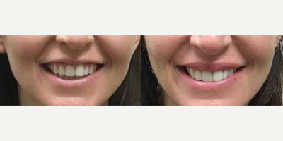 Case 5166 - Woman treated with Botox