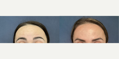 Case 5173 - 35-44 year old woman treated with Botox