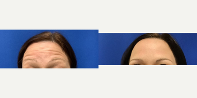 Case 5174 - 35-44 year old woman treated with Botox