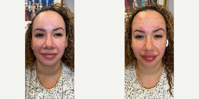 Case 5175 - 35-44 year old woman treated with Botox