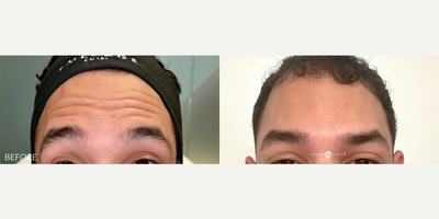 Case 5185 - Man treated with Botox