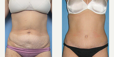 Case 519 - Woman treated with Tummy Tuck