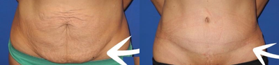 Case 52 - Woman treated with Tummy Tuck
