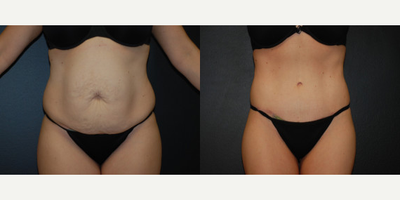 Case 520 - 40 year old woman treated with Tummy Tuck