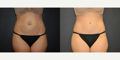 Case 521 - Woman treated with Tummy Tuck
