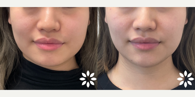 Case 5215 - 18-24 year old woman treated with Botox