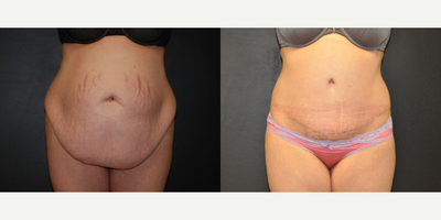 Case 522 - Woman treated with Tummy Tuck