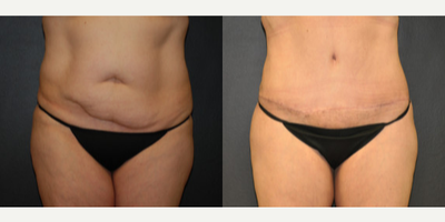 Case 523 - Woman treated with Tummy Tuck