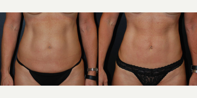 Case 524 - 52 year old woman treated with Tummy Tuck