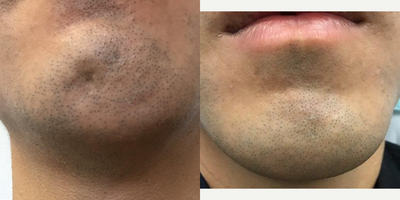 Case 5246 - 25-34 year old man treated with Botox