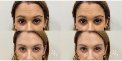 Case 5247 - 35-44 year old man treated with Botox