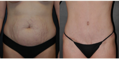 Case 525 - Woman treated with Tummy Tuck
