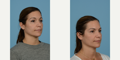 Case 5252 - 35-44 year old woman treated with Botox